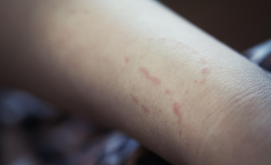 Child Bite Marks On Arm